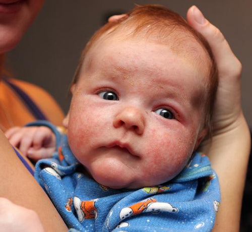 Qu'est ce qu'une peau extrêmement sèche? - Mustela Canada - 1