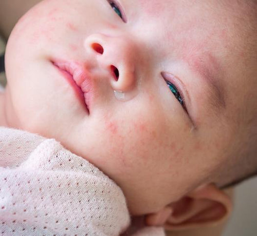 Mon bébé dort mal à cause de l'eczéma atopique, que faire? - Mustela Canada - 1